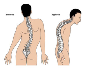 kyphosis-treatment-surgery-in-pune
