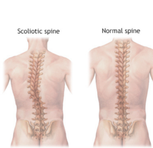scoliosis-treatment-in-pune-pcmc