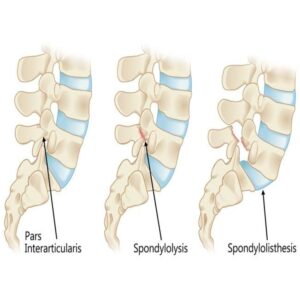 spondiloliosthesis-treatment-in-pune