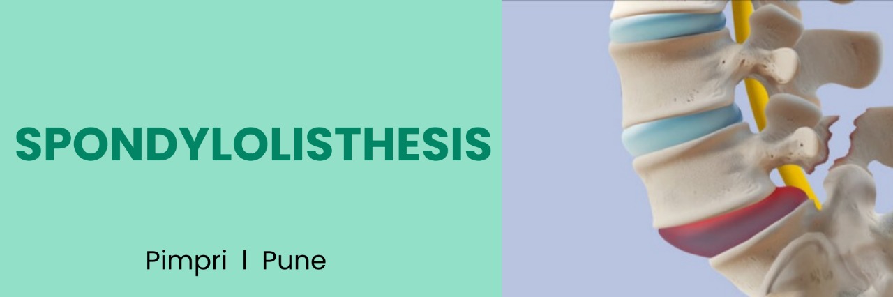 Spondylolisthesis Treatment