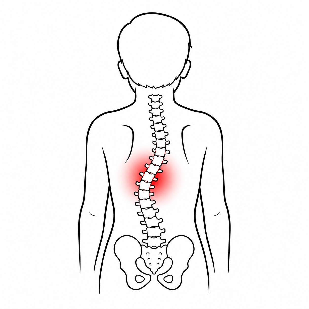 Congenital Scoliosis