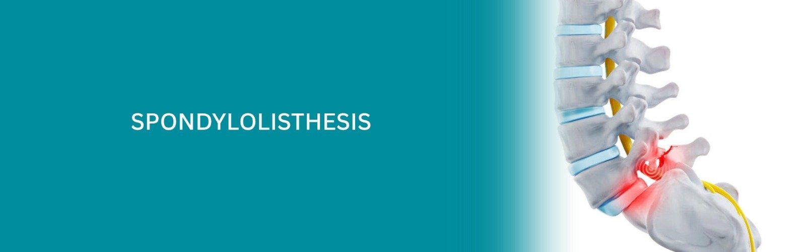 Spondylolisthesis Treatment