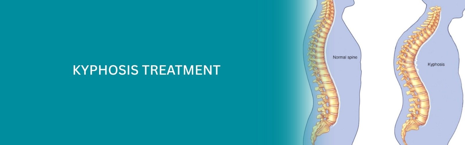 Kyphosis Treatment