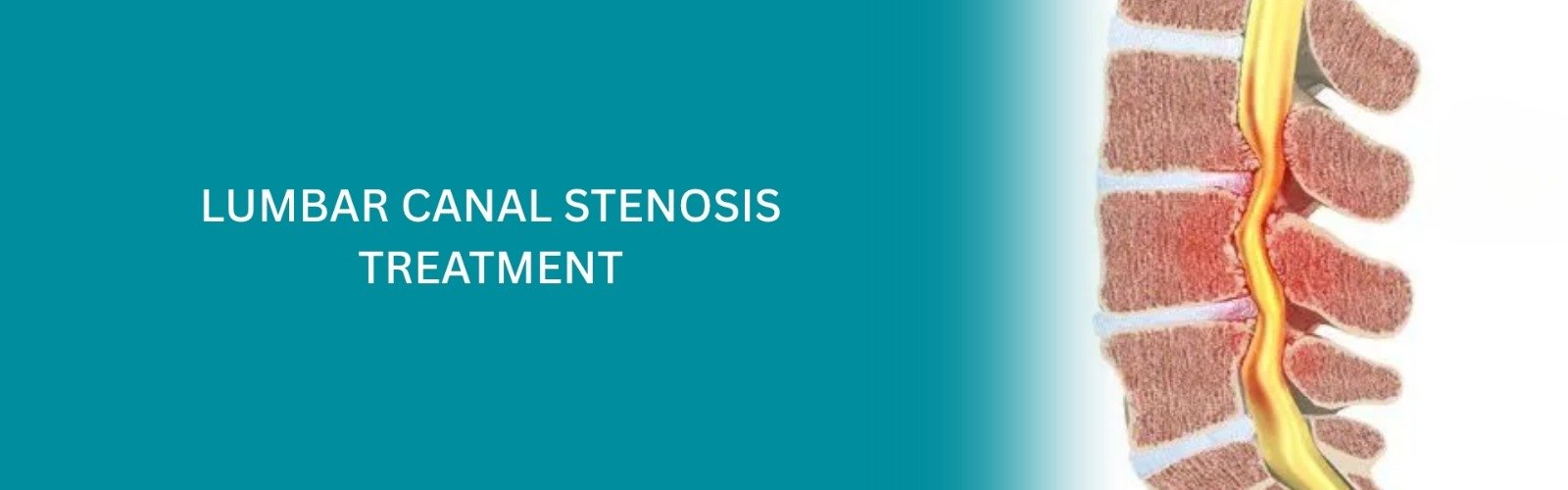 Lumbar Canal Stenosis Treatment